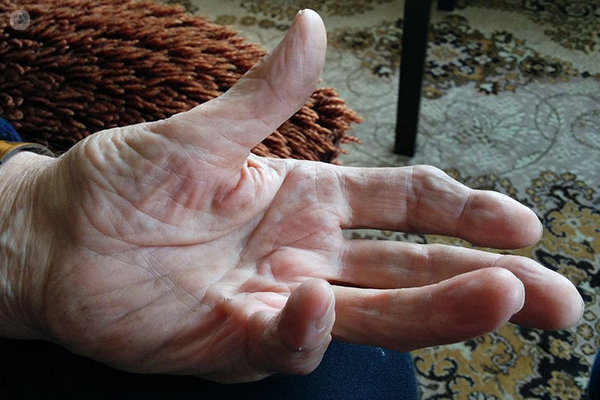 Dupuytren's Contracture