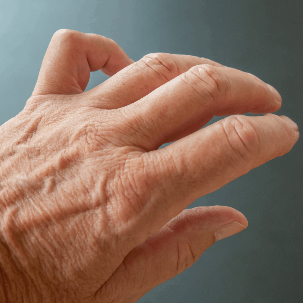 Hand affected by Dupuytren's disease with contracted pinky finger