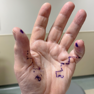 Dupuytren's Hand Prior to Surgery